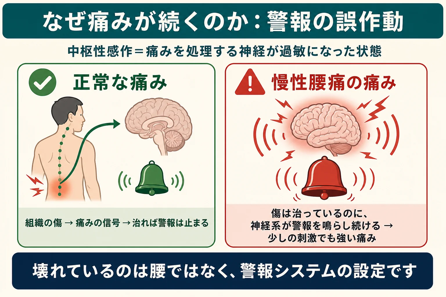 中枢性感作の図解:正常な痛みは治れば警報が止まるが、慢性腰痛では傷が治っても神経系が警報を鳴らし続ける